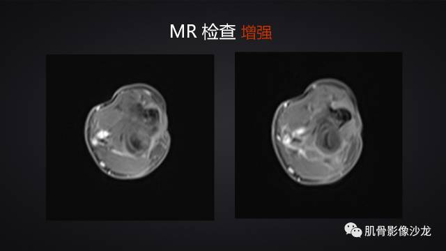 【病例】骨化性纤维瘤两例影像讨论 【病例】骨化性纤维瘤两例影像讨论