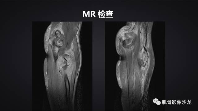 【病例】骨化性纤维瘤两例影像讨论 【病例】骨化性纤维瘤两例影像讨论