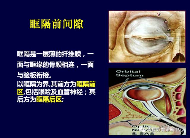 【PPT】常见眼眶内肿瘤的影像诊断分析