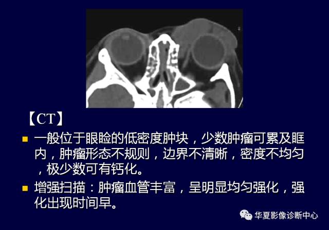 【PPT】常见眼眶内肿瘤的影像诊断分析