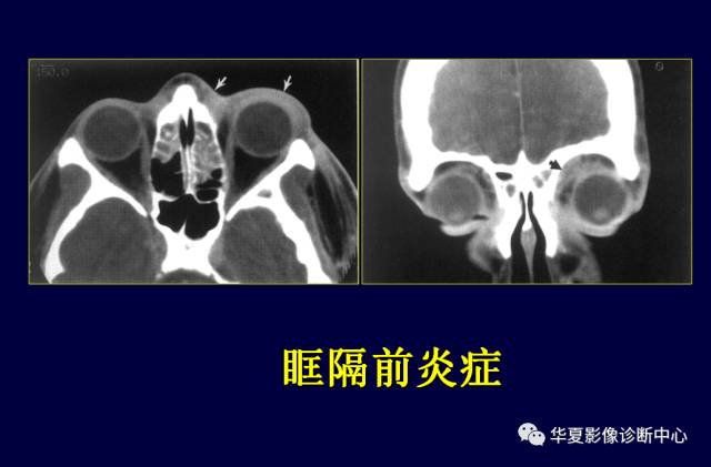 【PPT】常见眼眶内肿瘤的影像诊断分析