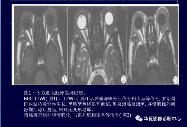 【PPT】常见眼眶内肿瘤的影像诊断分析