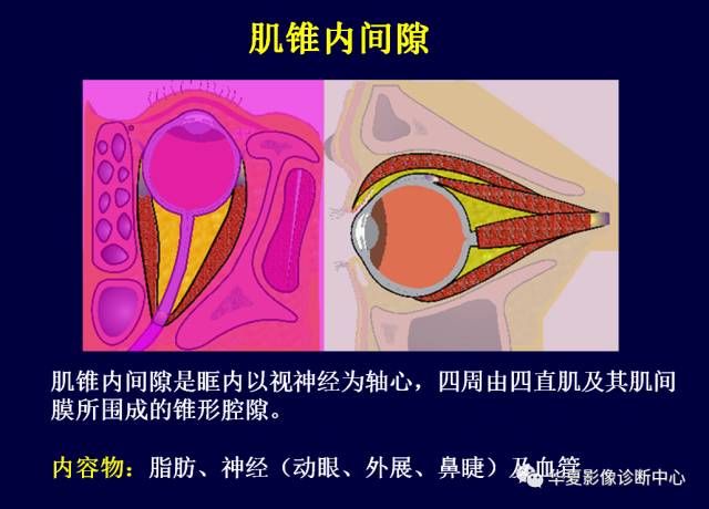 【PPT】常见眼眶内肿瘤的影像诊断分析