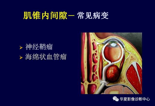【PPT】常见眼眶内肿瘤的影像诊断分析