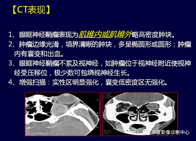 【PPT】常见眼眶内肿瘤的影像诊断分析