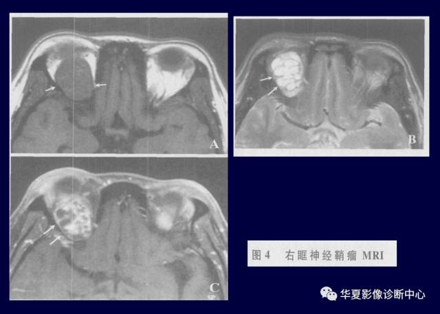 【PPT】常见眼眶内肿瘤的影像诊断分析