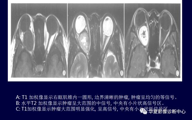 【PPT】常见眼眶内肿瘤的影像诊断分析