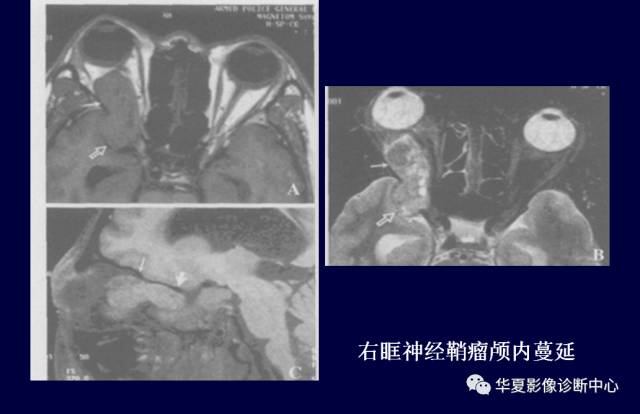 【PPT】常见眼眶内肿瘤的影像诊断分析