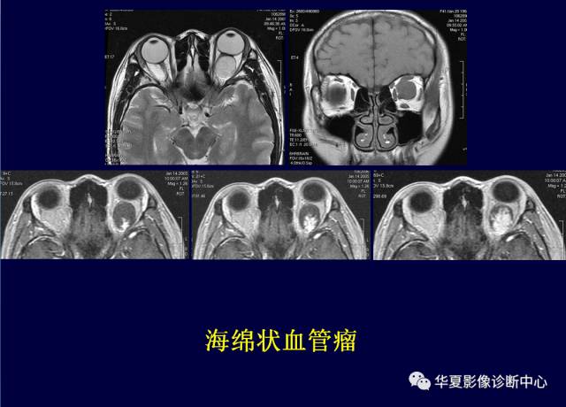 【PPT】常见眼眶内肿瘤的影像诊断分析