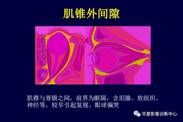 【PPT】常见眼眶内肿瘤的影像诊断分析