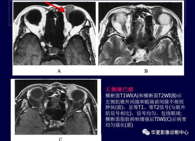 【PPT】常见眼眶内肿瘤的影像诊断分析
