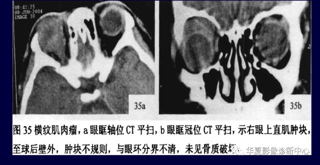 【PPT】常见眼眶内肿瘤的影像诊断分析
