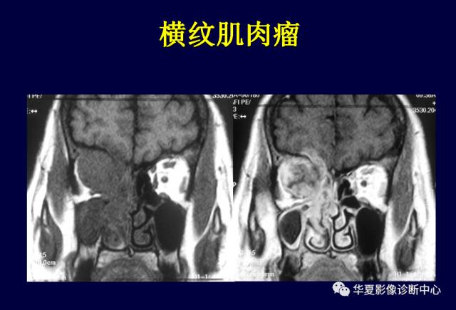 【PPT】常见眼眶内肿瘤的影像诊断分析