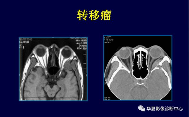 【PPT】常见眼眶内肿瘤的影像诊断分析
