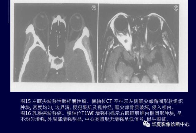 【PPT】常见眼眶内肿瘤的影像诊断分析