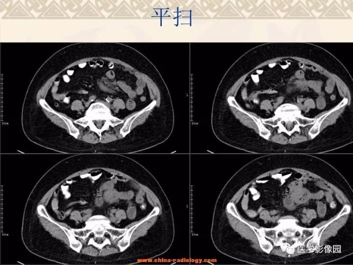 【病例】小肠间质瘤与肠腔贯通1例CT影像表现 【病例】小肠间质瘤与肠腔贯通1例CT影像表现