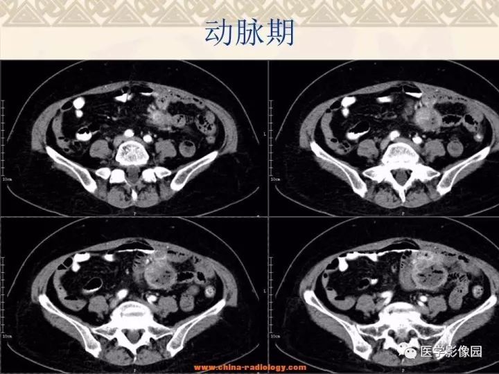 【病例】小肠间质瘤与肠腔贯通1例CT影像表现 【病例】小肠间质瘤与肠腔贯通1例CT影像表现