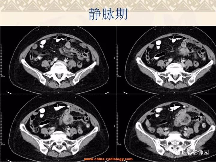 【病例】小肠间质瘤与肠腔贯通1例CT影像表现 【病例】小肠间质瘤与肠腔贯通1例CT影像表现