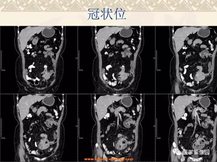 【病例】小肠间质瘤与肠腔贯通1例CT影像表现 【病例】小肠间质瘤与肠腔贯通1例CT影像表现