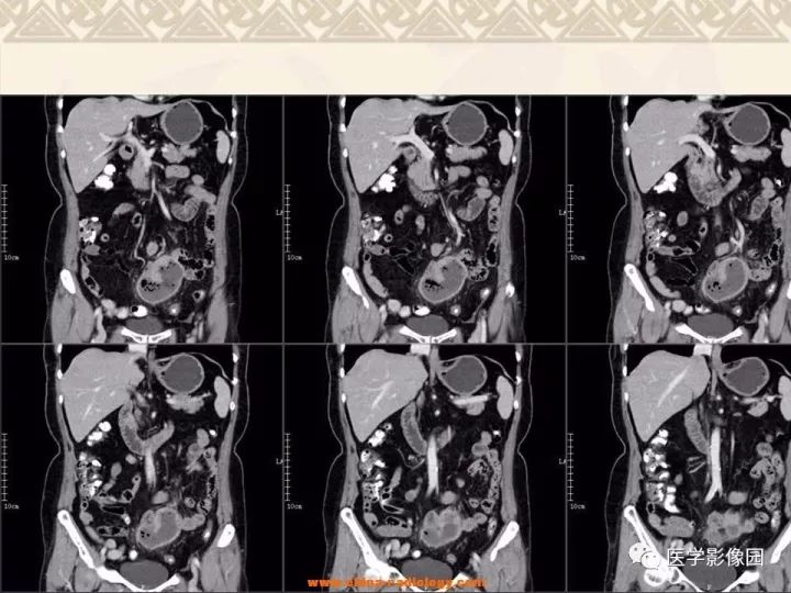 【病例】小肠间质瘤与肠腔贯通1例CT影像表现 【病例】小肠间质瘤与肠腔贯通1例CT影像表现
