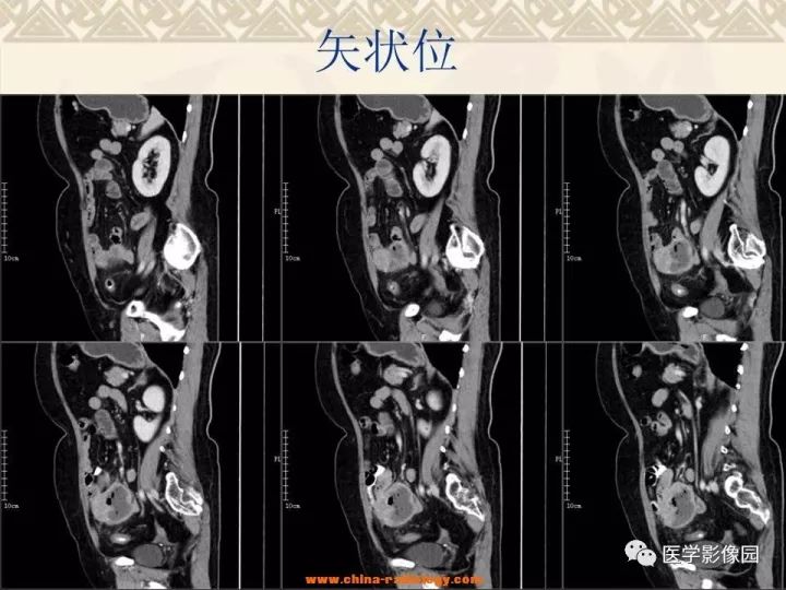 【病例】小肠间质瘤与肠腔贯通1例CT影像表现 【病例】小肠间质瘤与肠腔贯通1例CT影像表现