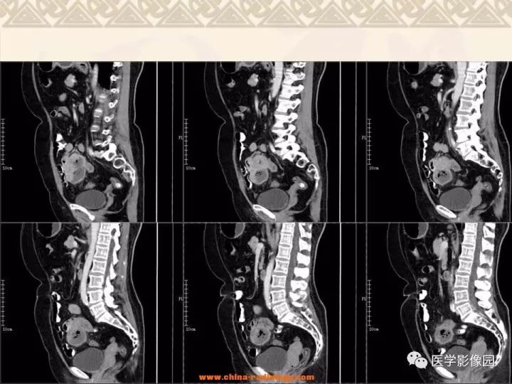 【病例】小肠间质瘤与肠腔贯通1例CT影像表现 【病例】小肠间质瘤与肠腔贯通1例CT影像表现
