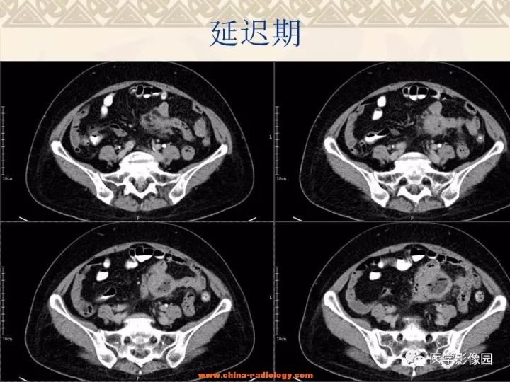 【病例】小肠间质瘤与肠腔贯通1例CT影像表现 【病例】小肠间质瘤与肠腔贯通1例CT影像表现