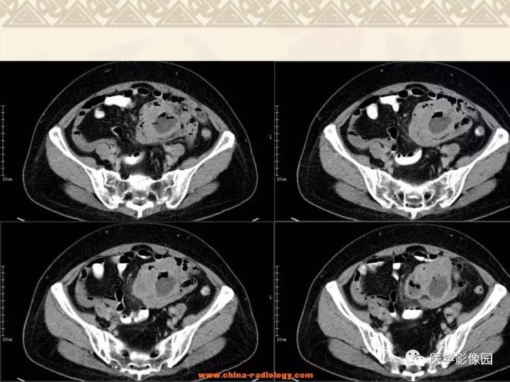 【病例】小肠间质瘤与肠腔贯通1例CT影像表现 【病例】小肠间质瘤与肠腔贯通1例CT影像表现