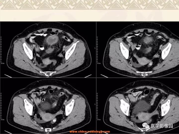 【病例】小肠间质瘤与肠腔贯通1例CT影像表现 【病例】小肠间质瘤与肠腔贯通1例CT影像表现