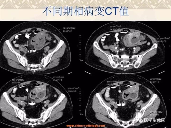 【病例】小肠间质瘤与肠腔贯通1例CT影像表现 【病例】小肠间质瘤与肠腔贯通1例CT影像表现