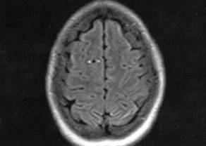 【病例】脑内静脉畸形1例MR影像表现 【病例】脑内静脉畸形1例MR影像表现