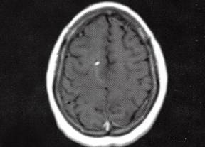 【病例】脑内静脉畸形1例MR影像表现 【病例】脑内静脉畸形1例MR影像表现