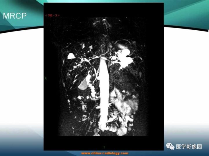 【病例】多器官受累肉芽肿性疾病—朗格罕斯细胞组织细胞增生症1例CT及MR 【病例】多器官受累肉芽肿性疾病—朗格罕斯细胞组织细胞增生症1例CT及MR