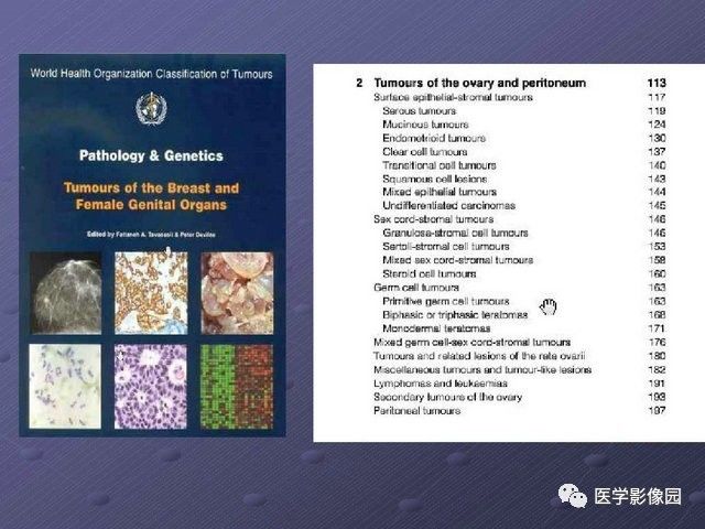 【PPT】卵巢肿瘤CT影像诊断