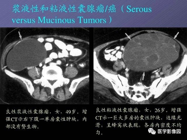 【PPT】卵巢肿瘤CT影像诊断