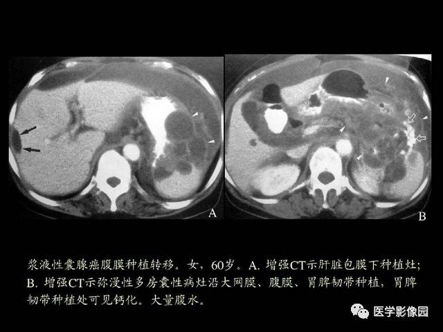 【PPT】卵巢肿瘤CT影像诊断