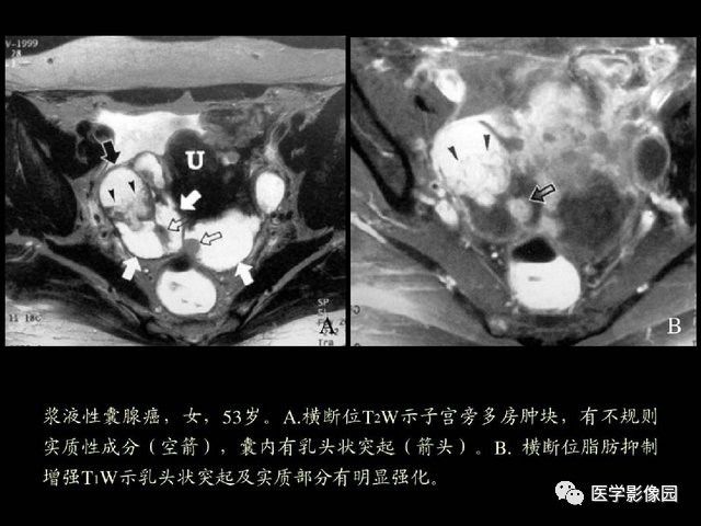 【PPT】卵巢肿瘤CT影像诊断