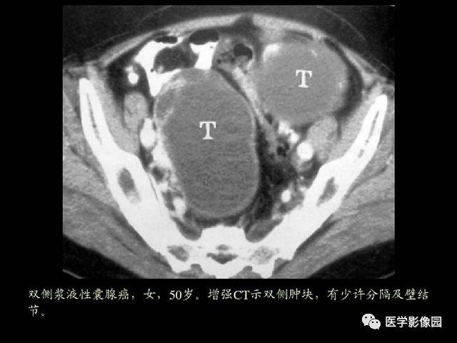 【PPT】卵巢肿瘤CT影像诊断