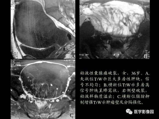 【PPT】卵巢肿瘤CT影像诊断