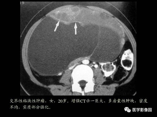 【PPT】卵巢肿瘤CT影像诊断
