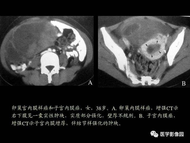 【PPT】卵巢肿瘤CT影像诊断