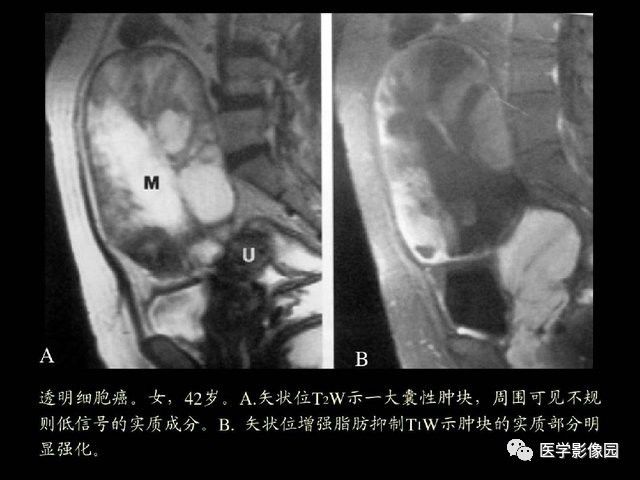 【PPT】卵巢肿瘤CT影像诊断