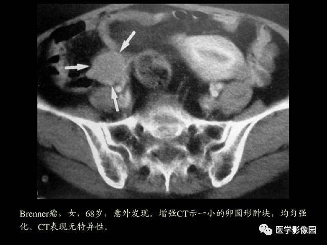 【PPT】卵巢肿瘤CT影像诊断