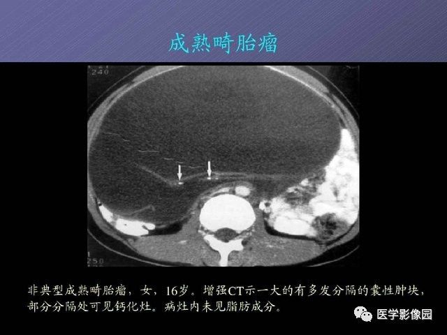 【PPT】卵巢肿瘤CT影像诊断