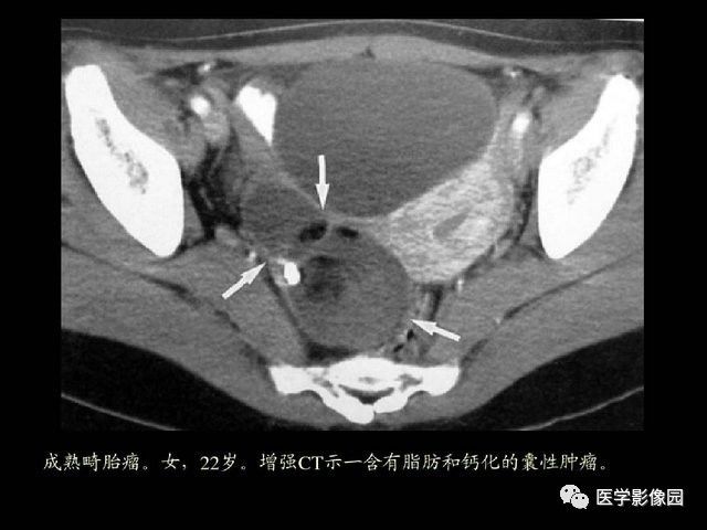 【PPT】卵巢肿瘤CT影像诊断