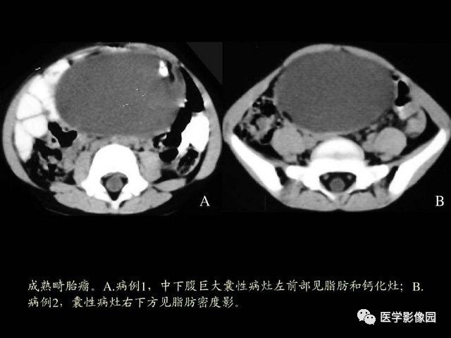 【PPT】卵巢肿瘤CT影像诊断