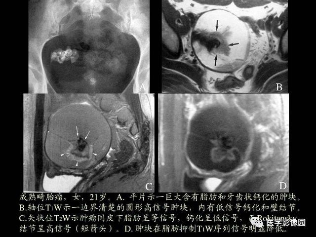 【PPT】卵巢肿瘤CT影像诊断