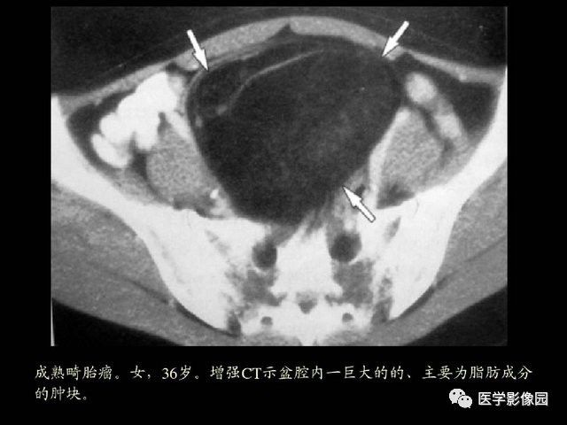 【PPT】卵巢肿瘤CT影像诊断