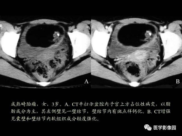 【PPT】卵巢肿瘤CT影像诊断
