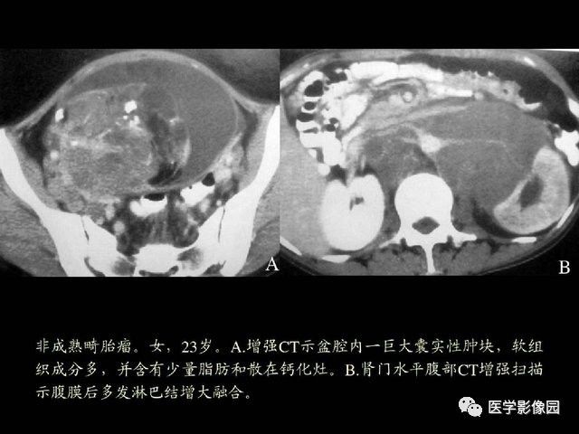 【PPT】卵巢肿瘤CT影像诊断